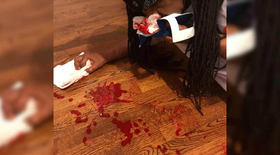 Nile Rodgers compartilha vídeo sangrando após quebrar o nariz