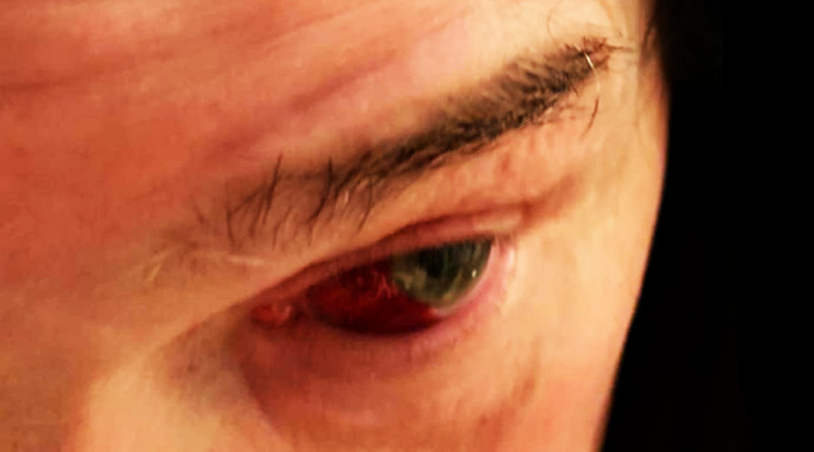 Ozzy Osbourne culpa tosse forte por rompimento de vaso sanguíneo do olho